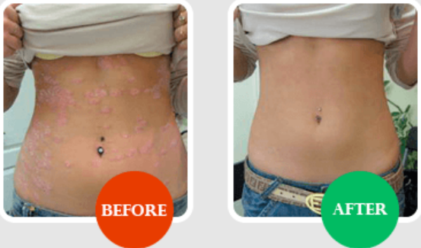Psorifix Anti-Psoriasis Cream, Price, Where To Buy In India?